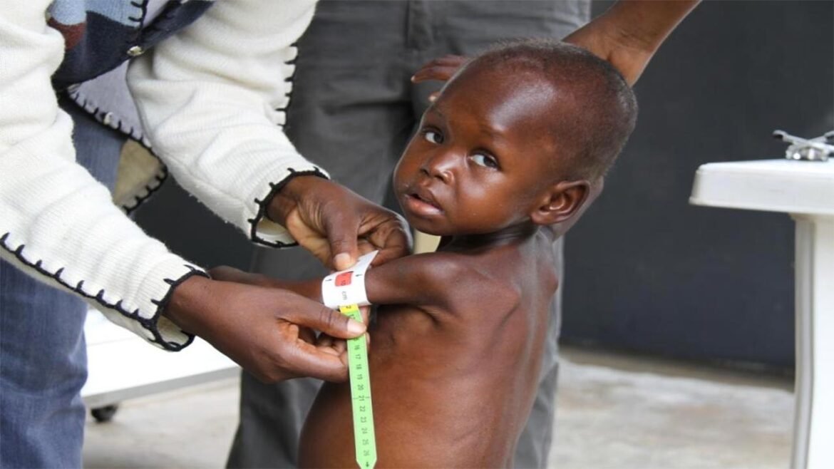 1685024173689 malnutrition